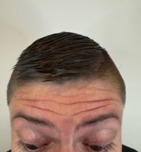 caso 1 antes saint clinica dermatologica 01