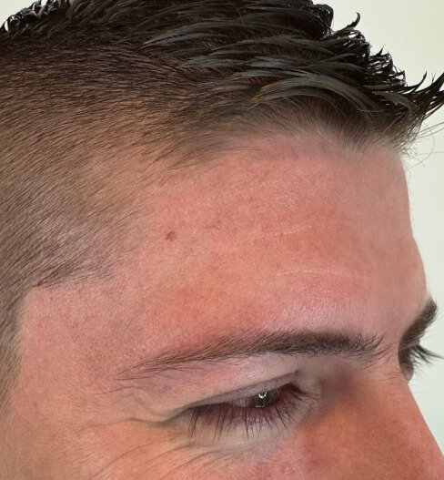 caso 1 antes saint clinica dermatologica 02