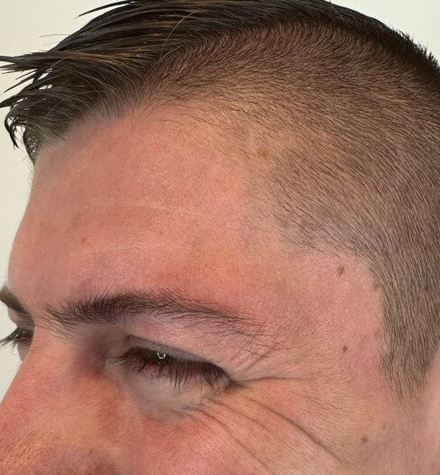 caso 1 antes saint clinica dermatologica 03