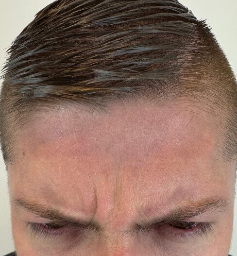 caso 1 antes saint clinica dermatologica 04