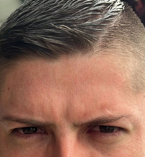 caso 1 despues saint clinica dermatologica 01