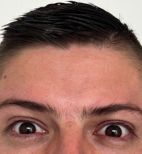 caso 1 despues saint clinica dermatologica 03