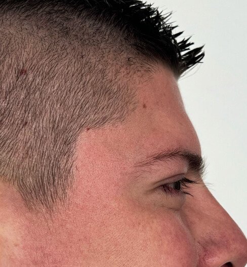 caso 1 despues saint clinica dermatologica 04