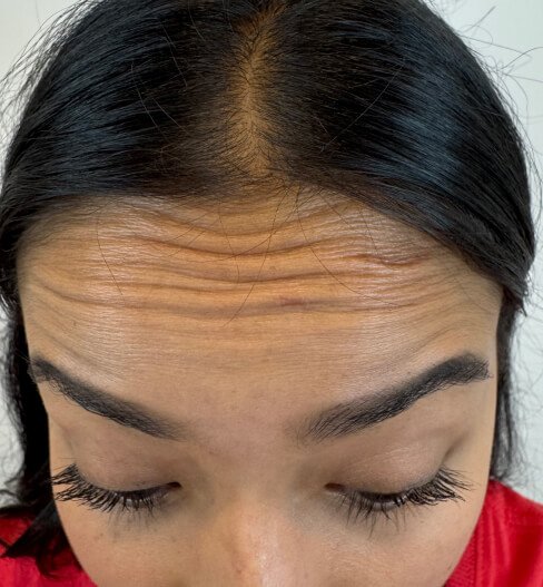 caso 2 antes saint clinica dermatologica 01