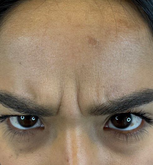 caso 2 antes saint clinica dermatologica 02