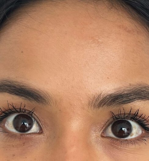 caso 2 despues saint clinica dermatologica 01