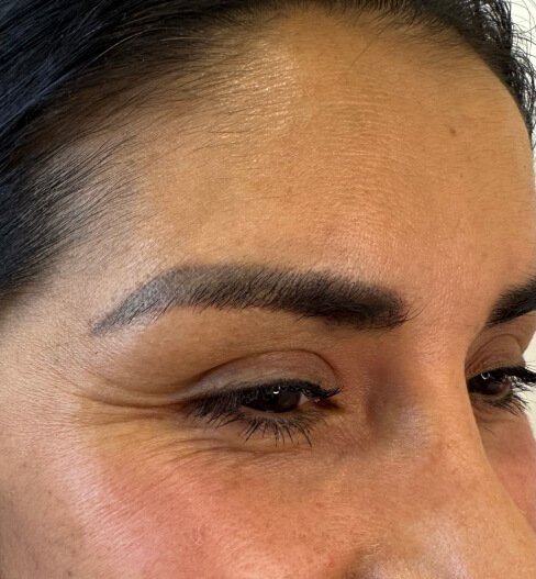 caso 3 antes saint clinica dermatologica 03