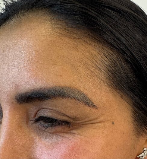 caso 3 antes saint clinica dermatologica 04