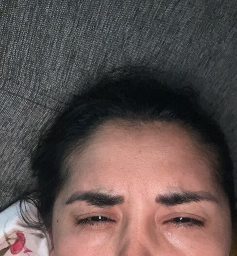 caso 3 despues saint clinica dermatologica 01