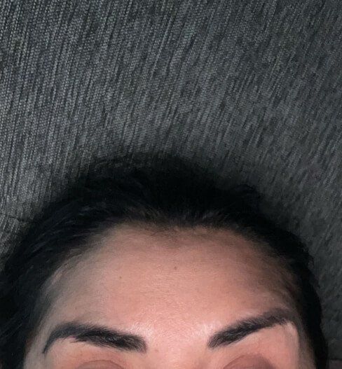 caso 3 despues saint clinica dermatologica 02