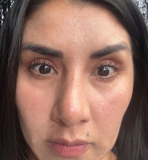 caso 3 despues saint clinica dermatologica 03