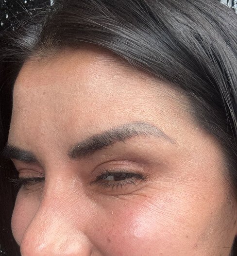 caso 3 despues saint clinica dermatologica 04