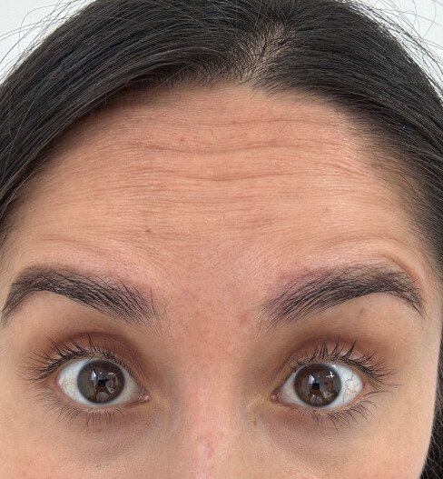 caso 4 antes saint clinica dermatologica 01