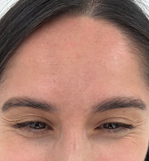 caso 4 antes saint clinica dermatologica 02