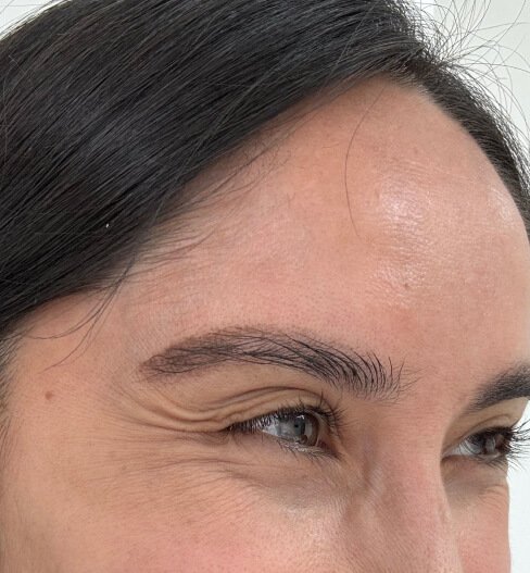 caso 4 antes saint clinica dermatologica 03