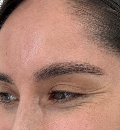 caso 4 antes saint clinica dermatologica 04