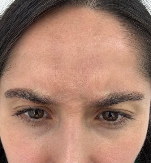 caso 4 antes saint clinica dermatologica 05