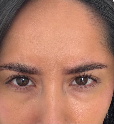 caso 4 despues saint clinica dermatologica 01