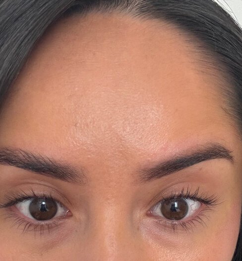 caso 4 despues saint clinica dermatologica 02