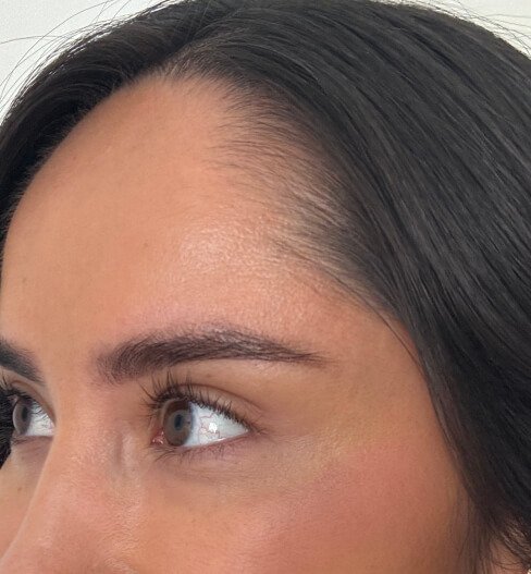 caso 4 despues saint clinica dermatologica 03