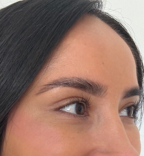 caso 4 despues saint clinica dermatologica 04