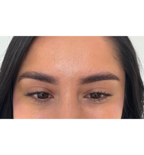 caso 4 despues saint clinica dermatologica 05